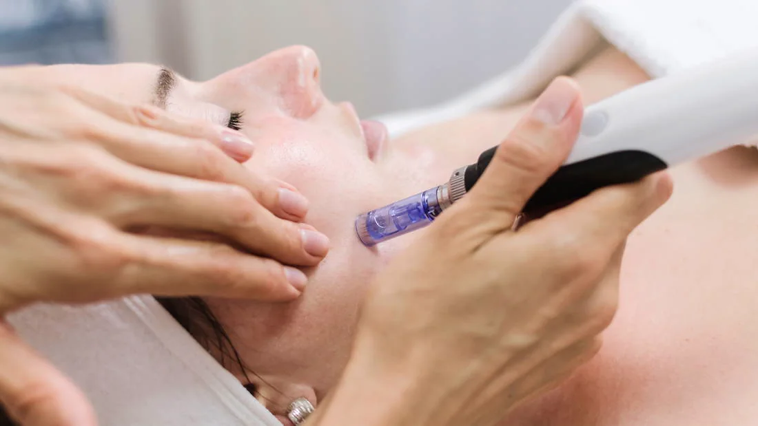 Microneedling facial treatment available at Respa Beauty